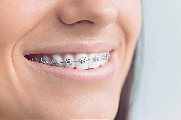 Best Invisalign and Clear Aligners  in West Vero Corridor, FL